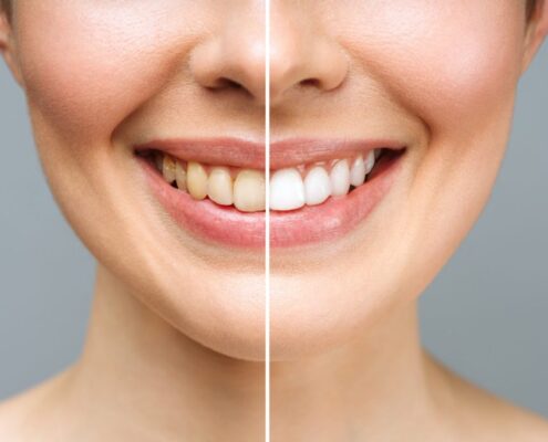 woman before and after teeth whitening