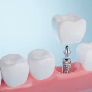 How Long Do Dental Implants Las