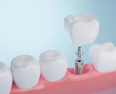 How Long Do Dental Implants Las